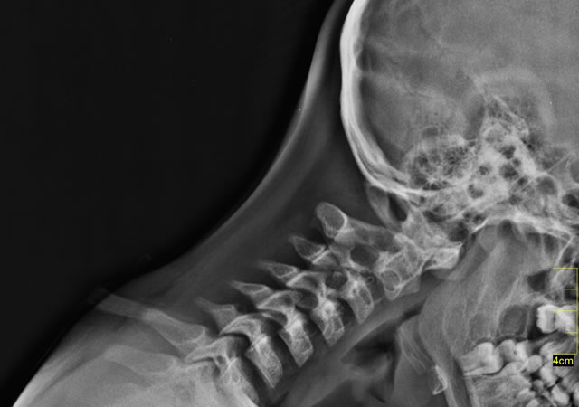 Cervical Flexión
