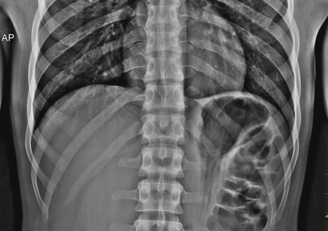Lumbar AP