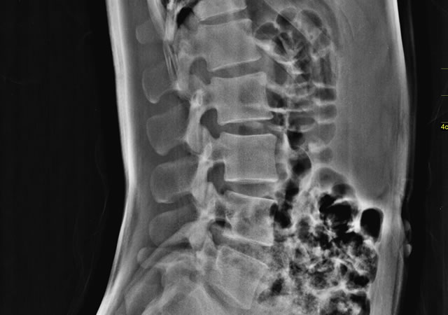 Lumbar Lateral