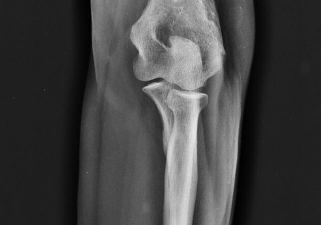 Antebrazo Lateral