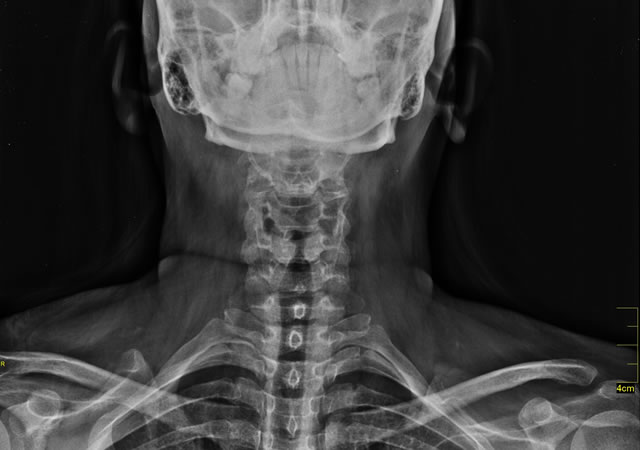 Cervical AP